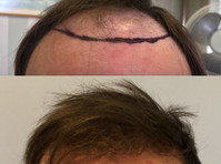 Harris Hair Transplant UK (3) - Chirurgia estetica