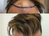 Harris Hair Transplant UK (4) - کاسمیٹک سرجری
