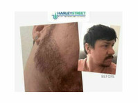 Harley Street Hair Transplant Clinic London (3) - Beauty Treatments