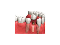 Full Dental Implants - Thorndent Dental care Center (2) - Zubní lékař
