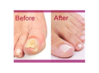 NailFungusHomeRemedy-TheAnti-fungalSolutionFromZetaClear (1) - Alternative Healthcare