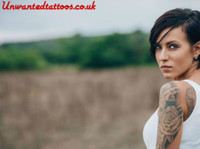 Unwanted Tattoos - Laser Tattoo Removal Specialist (1) - Козметични процедури