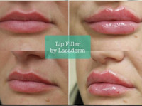 LasaDerm (2) - Cosmetic surgery