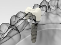 Martin Dentures and Implants (8) - Dentistes