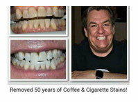Rock Star Teeth Whitening (1) - Dentisti