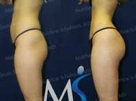 Matthew Schulman, MD (3) - Chirurgia plastyczna