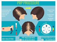 Prp Treatment For Hair Loss (1) - Третмани за убавина