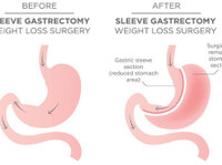 Sleeve Gastrectomy (3) - Cosmetische chirurgie