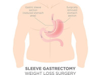 Sleeve Gastrectomy (4) - کاسمیٹک سرجری