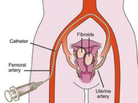 USA Fibroid Centers (2) - Hospitales & Clínicas