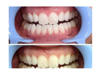 Lumina + Co. Teeth Whitening System (3) - Зъболекари