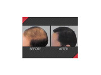Maxim Hair Restoration (1) - Третмани за убавина