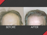 Maxim Hair Restoration (3) - Schönheitspflege